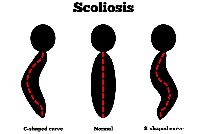 Denver, CO scoliosis treatment